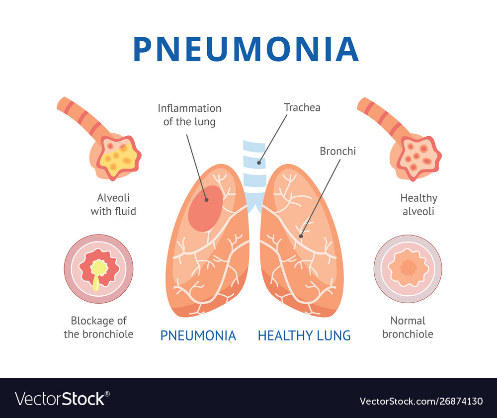 Lungs are healthy and diseased Royalty Free Vector Image