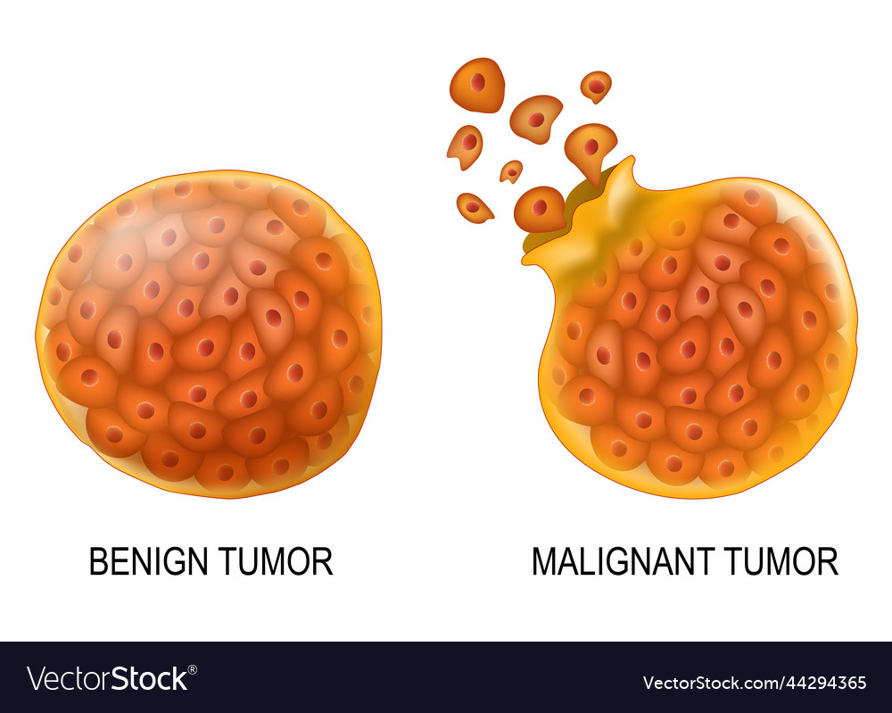 What Is Meant By Benign Neoplasm