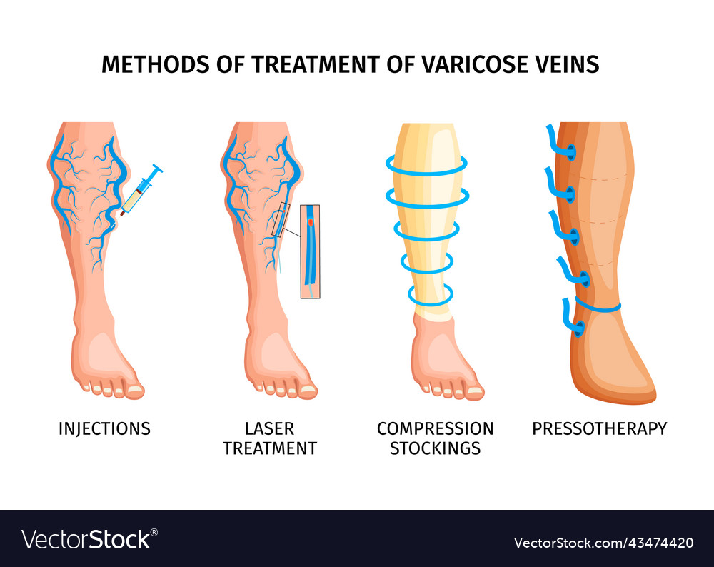Varicose Veins Treatment Revolutionary New Methods Revealed - vwjbhjm