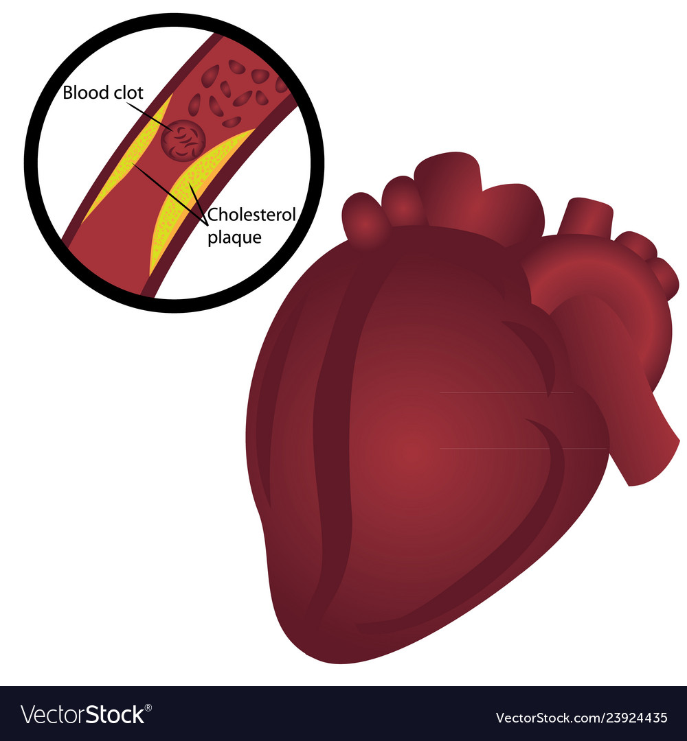 Blood clot cholesterol plaque i heart attack Vector Image