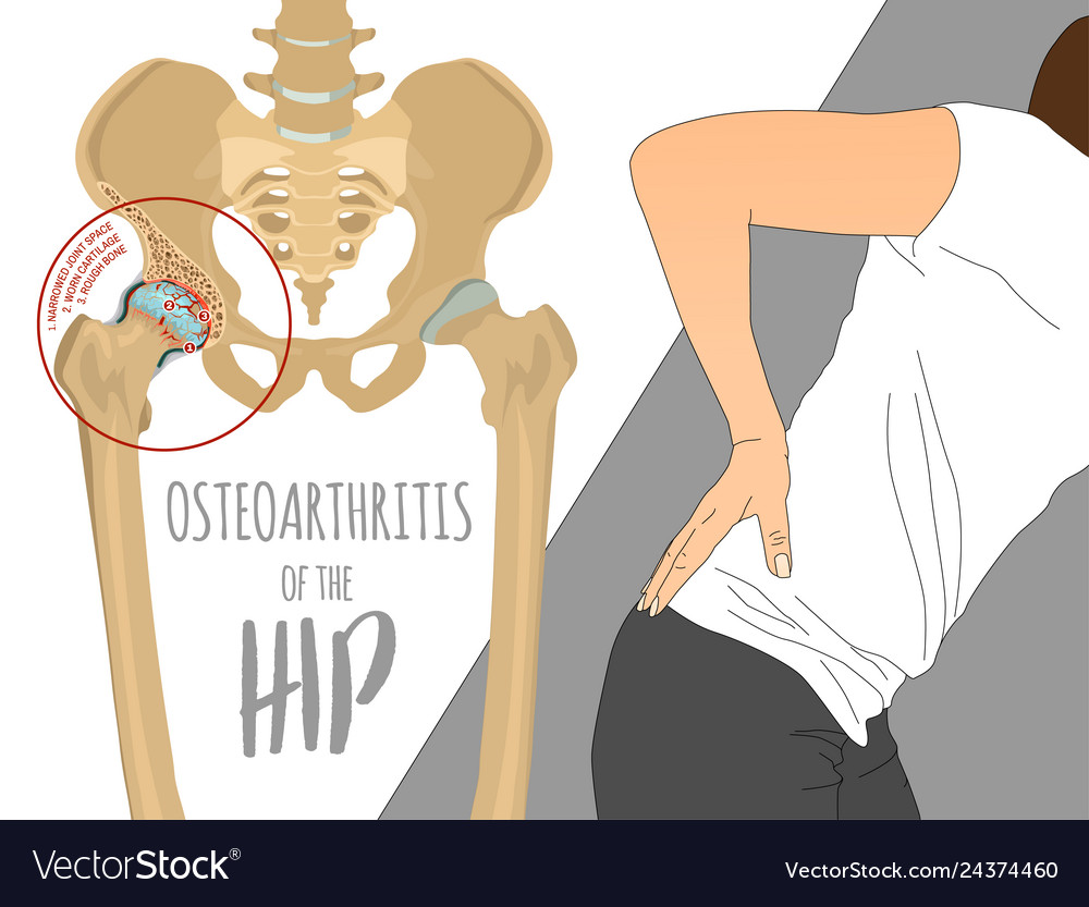 Hip osteoarthritis infographic