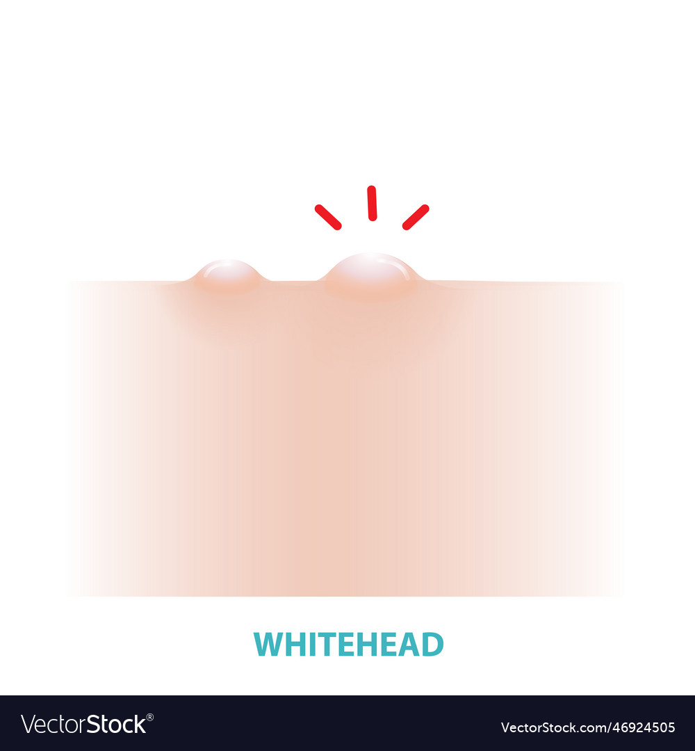 Whitehead acne