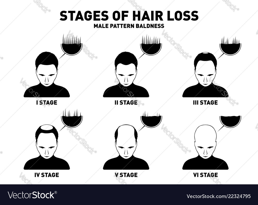 Hair Loss Stages And Types Of Male Hair Loss Male Vector Image