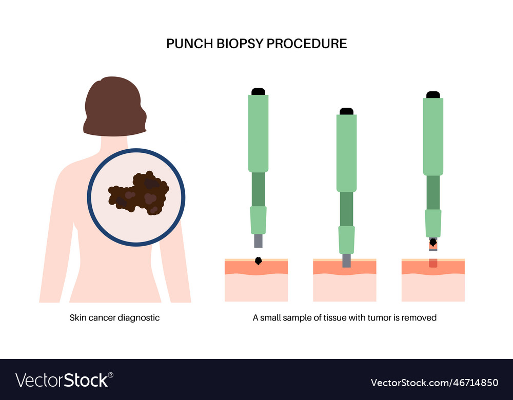 Punch biopsy procedure Royalty Free Vector Image