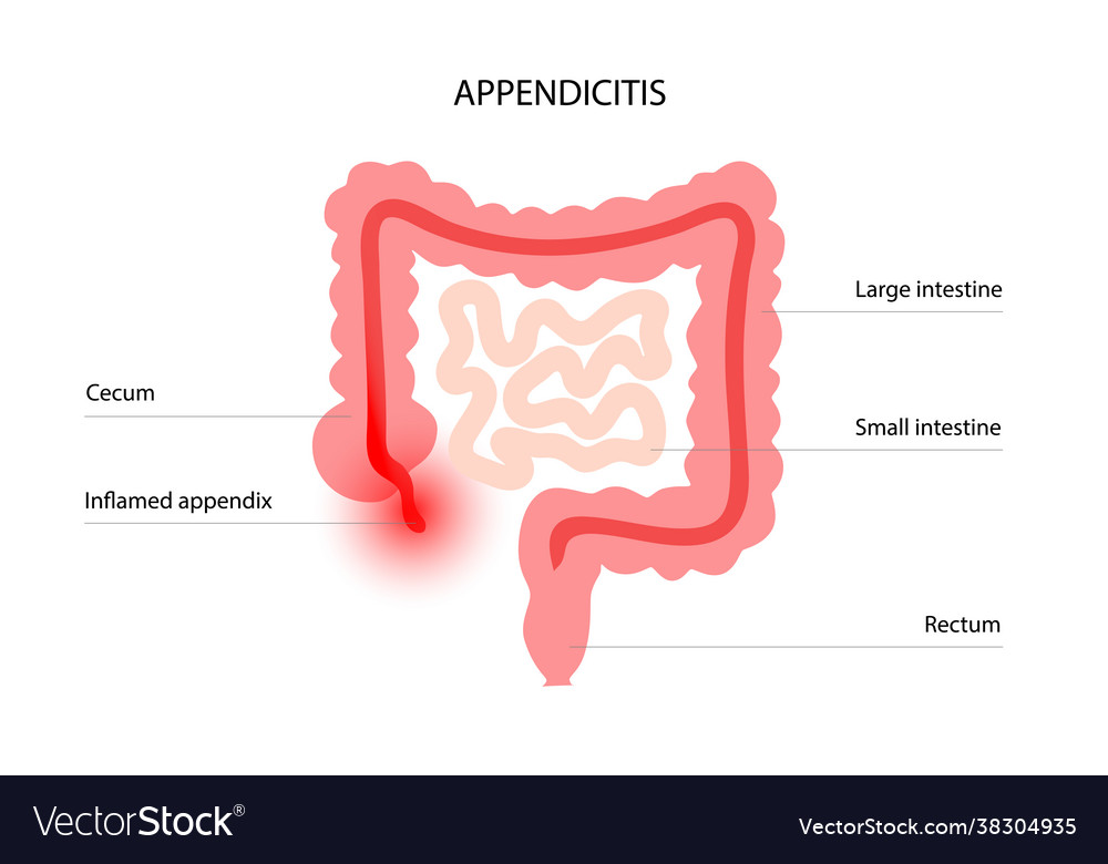 Appendix pain concept