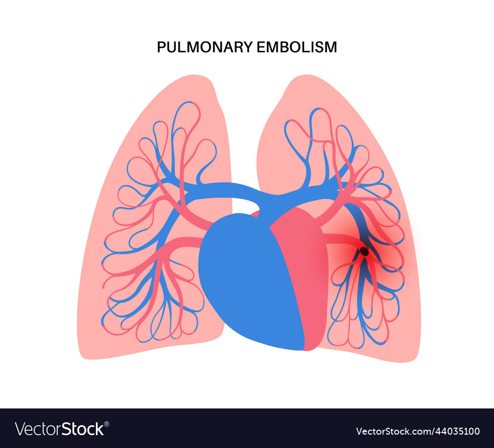 Pulmonary embolism disease Royalty Free Vector Image