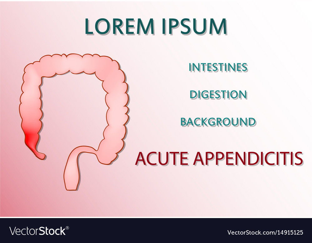 Acute Appendicitis Royalty Free Vector Image - Vectorstock