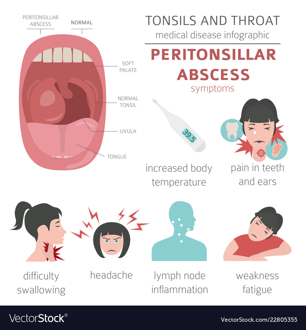 tonsil-abscess