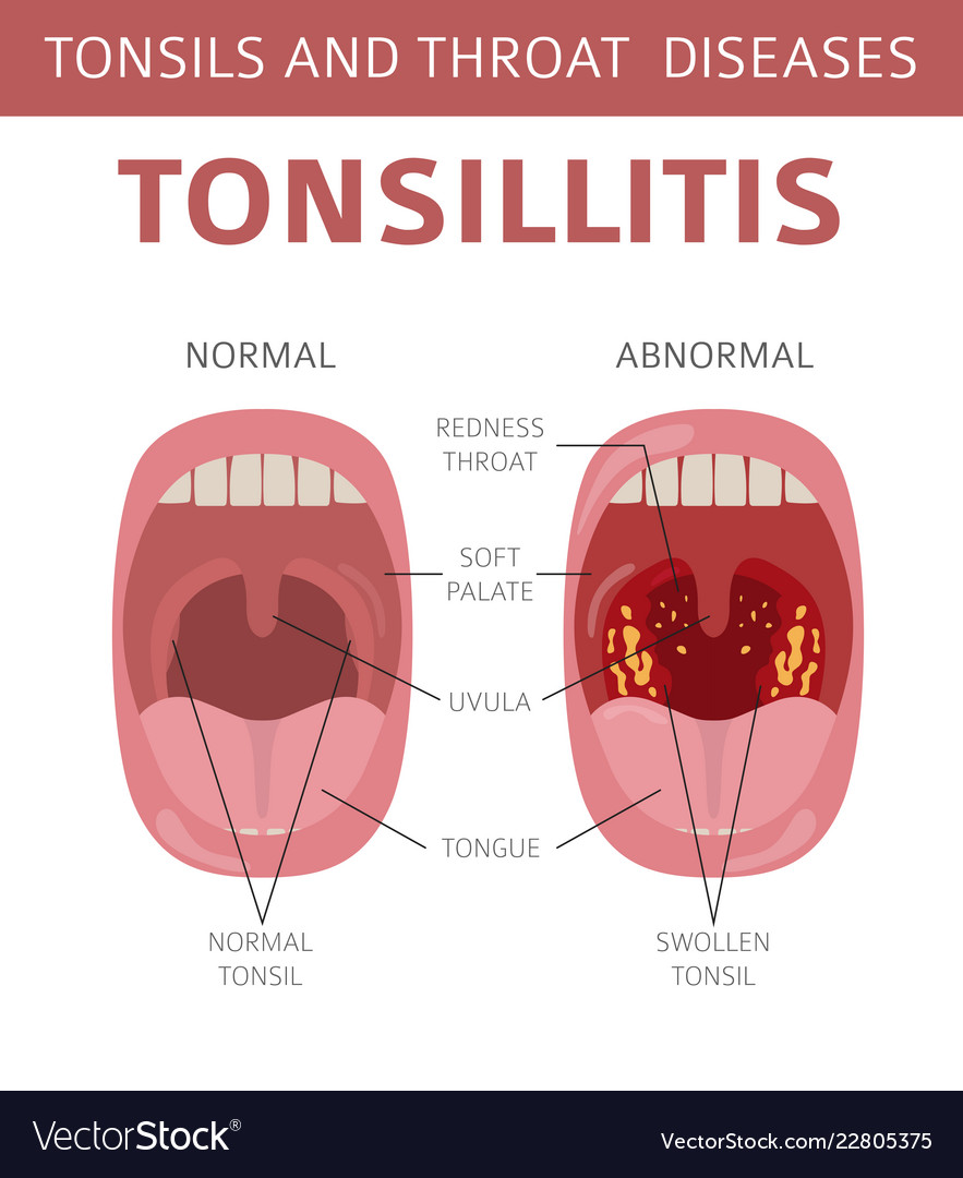 tonsils-and-throat-diseases-tonsillitis-symptoms-vector-image