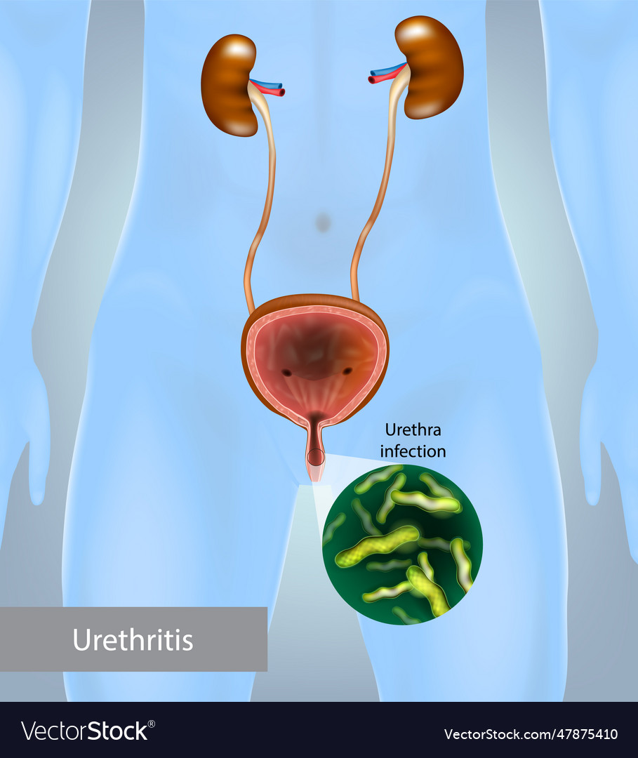 Urethritis is the inflammation of the urethra Vector Image