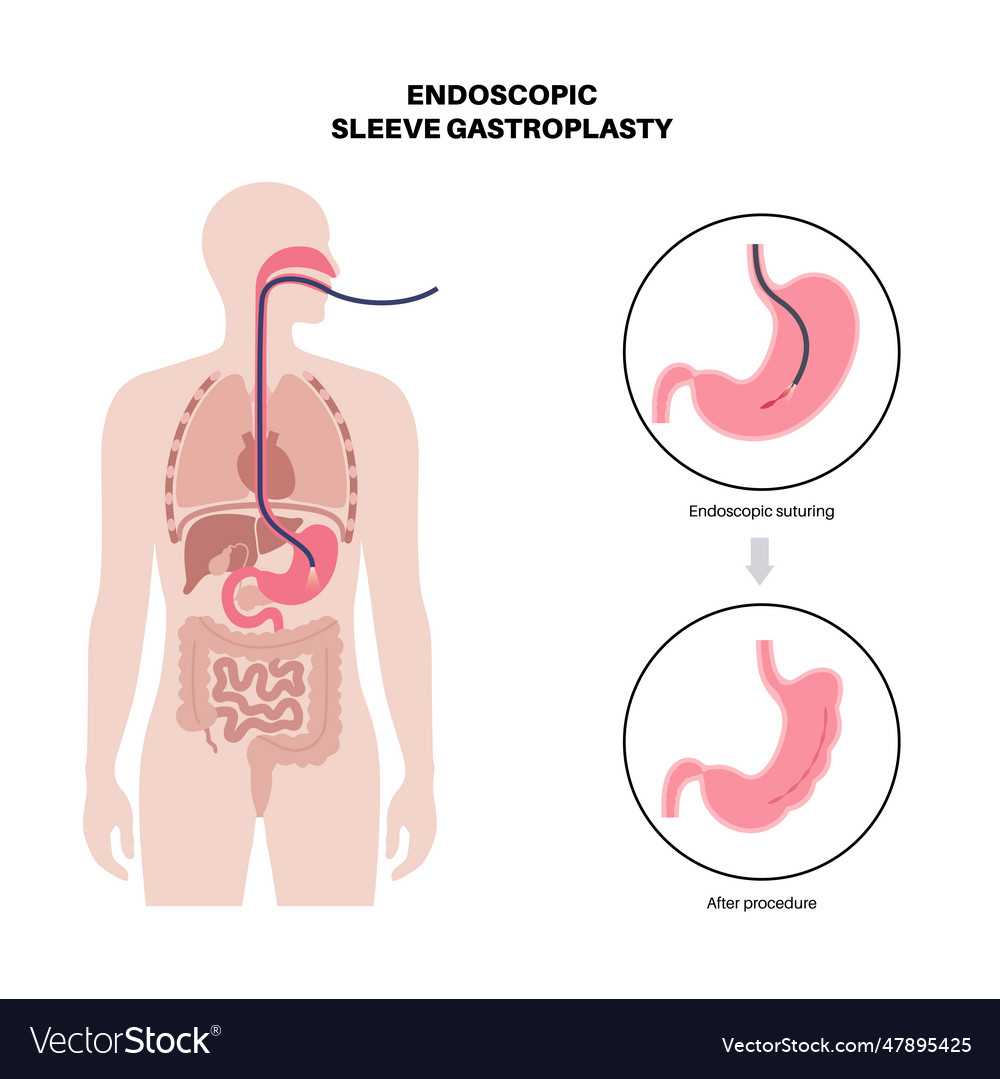 Endoscopic Sleeve Gastroplasty Royalty Free Vector Image