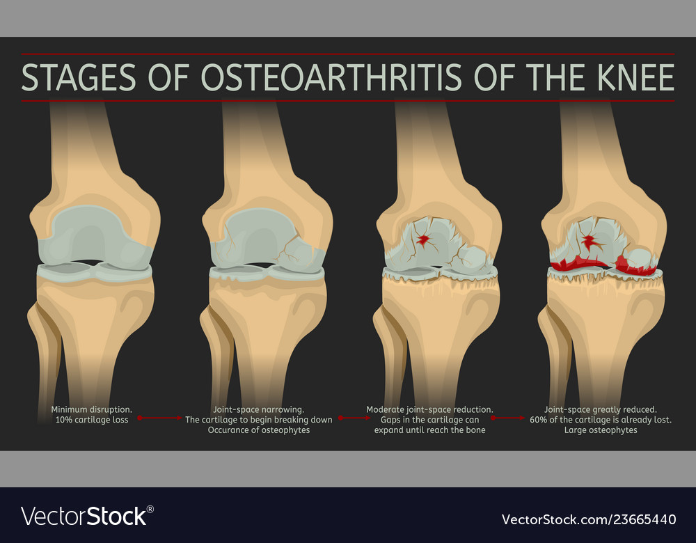 Stages Osteoarthritis Knee Royalty Free Vector Image