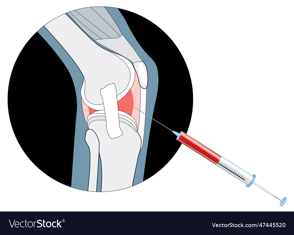 Injection into the painful joint Royalty Free Vector Image