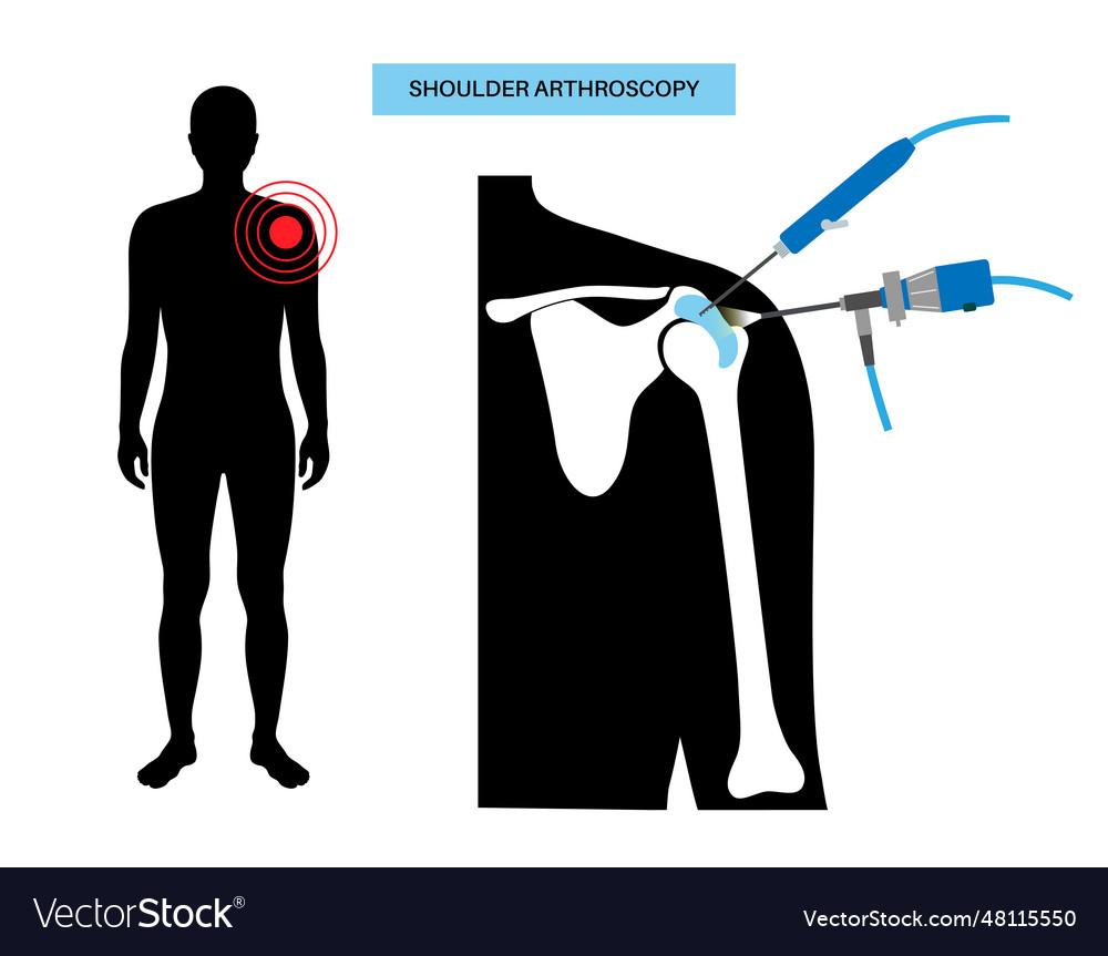 Shoulder arthroscopy poster Royalty Free Vector Image