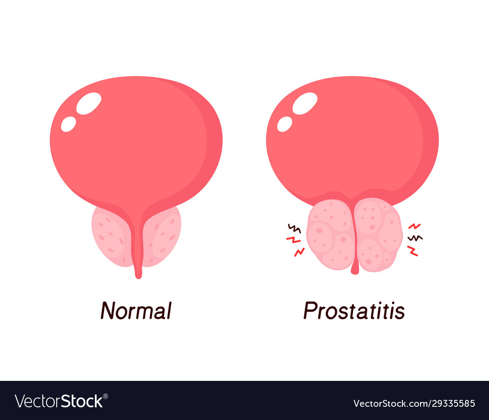 Normal prostate and benign prostatic hyperplasia Vector Image