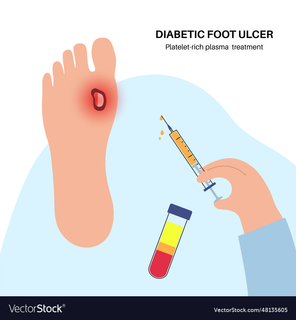 Diabetic foot ulcers Royalty Free Vector Image