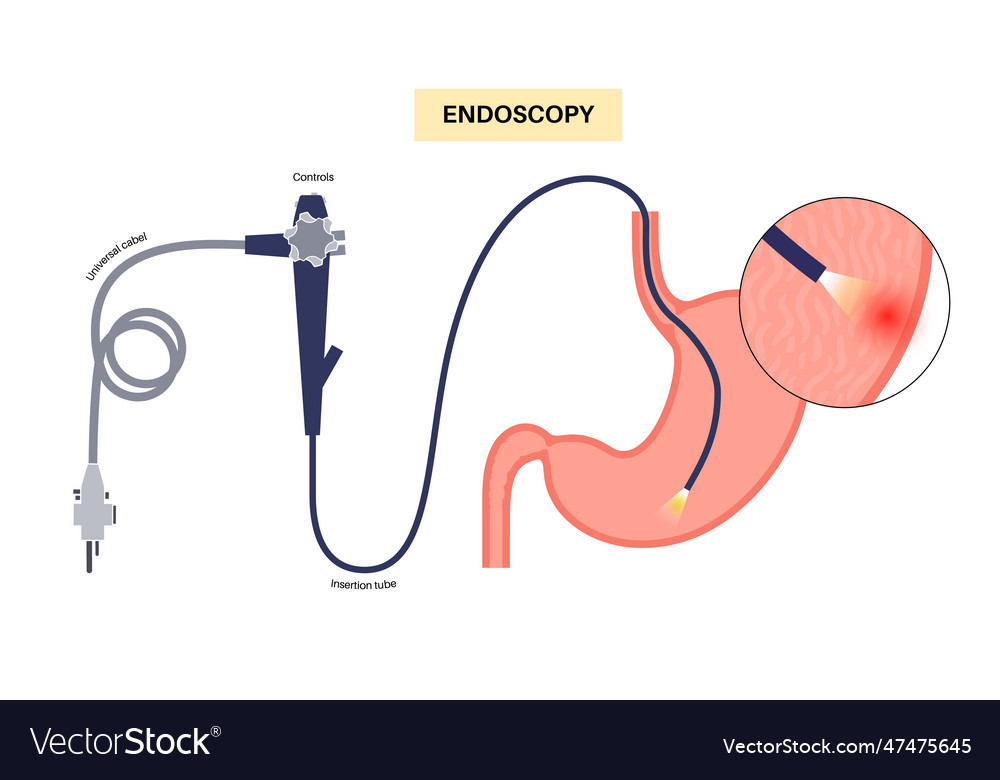 Gastroscopy Endoscopy Procedure Royalty Free Vector Image