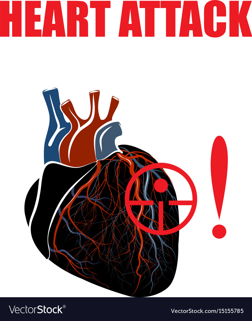 Heart myocardial infarction Royalty Free Vector Image