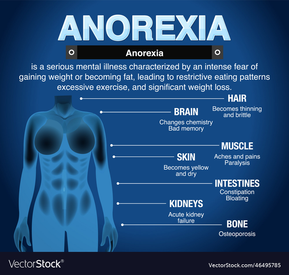 Informative poster of anorexia eating disorder