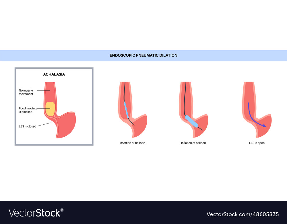 Endoscopic pneumatic dilation Royalty Free Vector Image