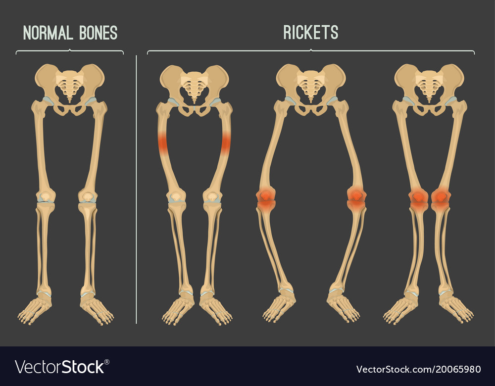 Rickets Scheme Royalty Free Vector Image VectorStock Rickets Scheme Royalty Free Vector Image VectorStock
