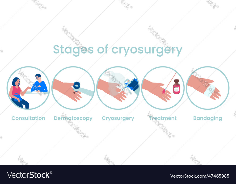 Stages of the cryosurgery procedure