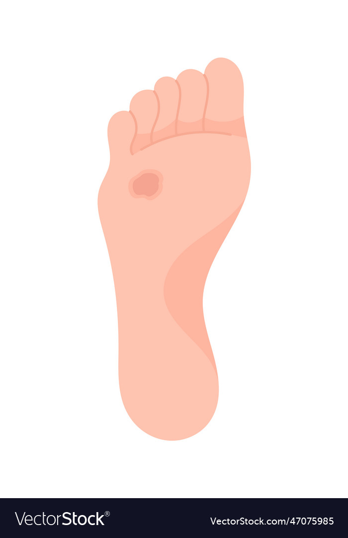 Superlicial ulcer foot disease Royalty Free Vector Image