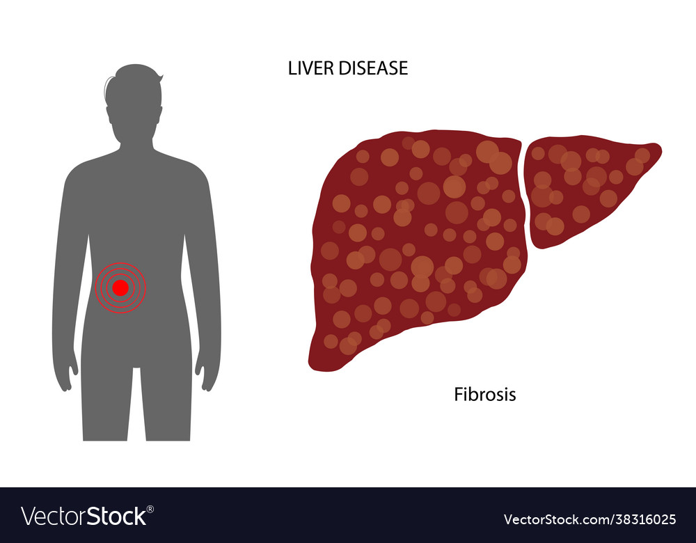 Liver disease concept Royalty Free Vector Image