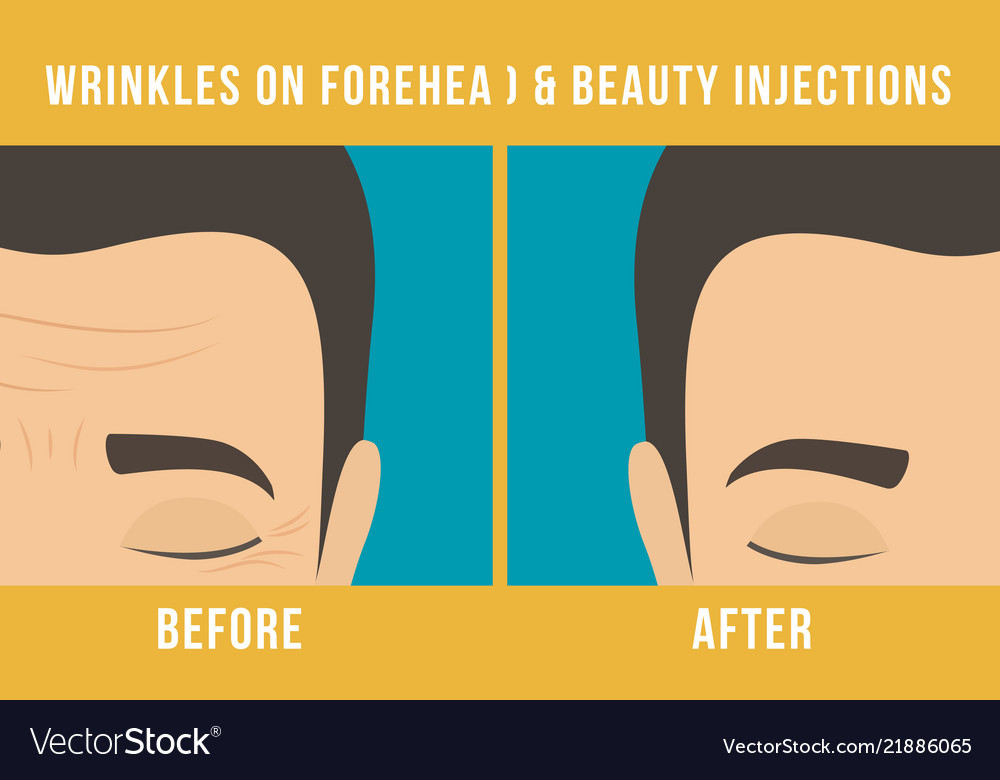 Cosmetic procedures botox Royalty Free Vector Image