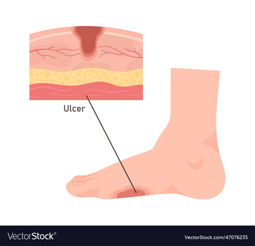 Foot ulcer disease Royalty Free Vector Image - VectorStock