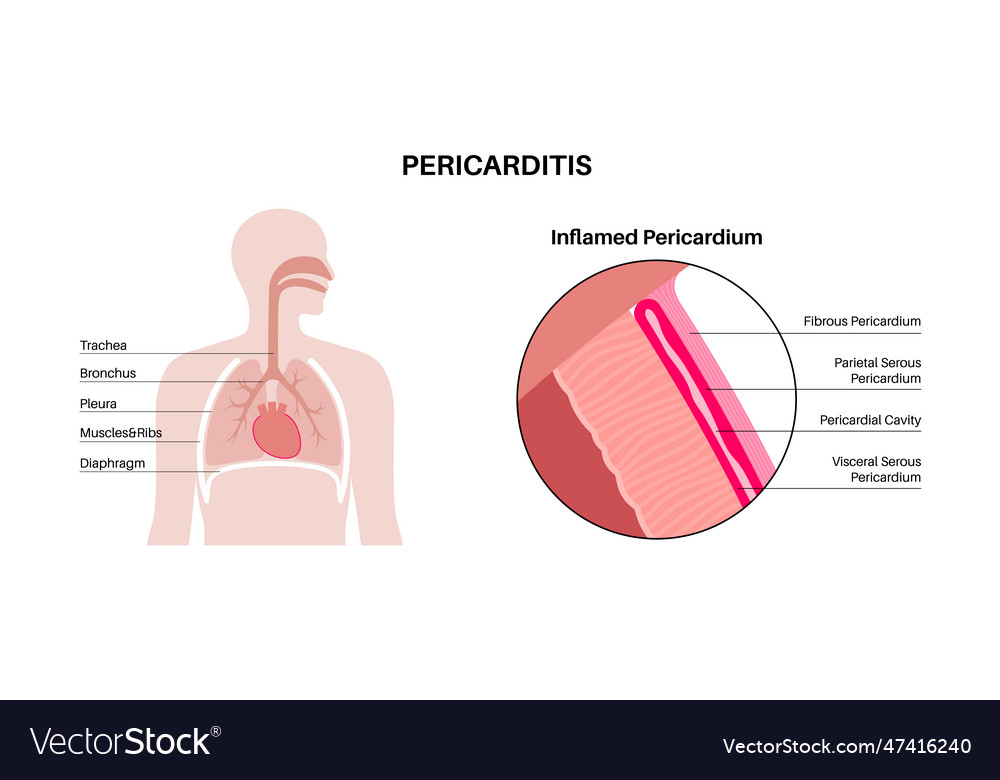 Pericarditis heart disease Royalty Free Vector Image