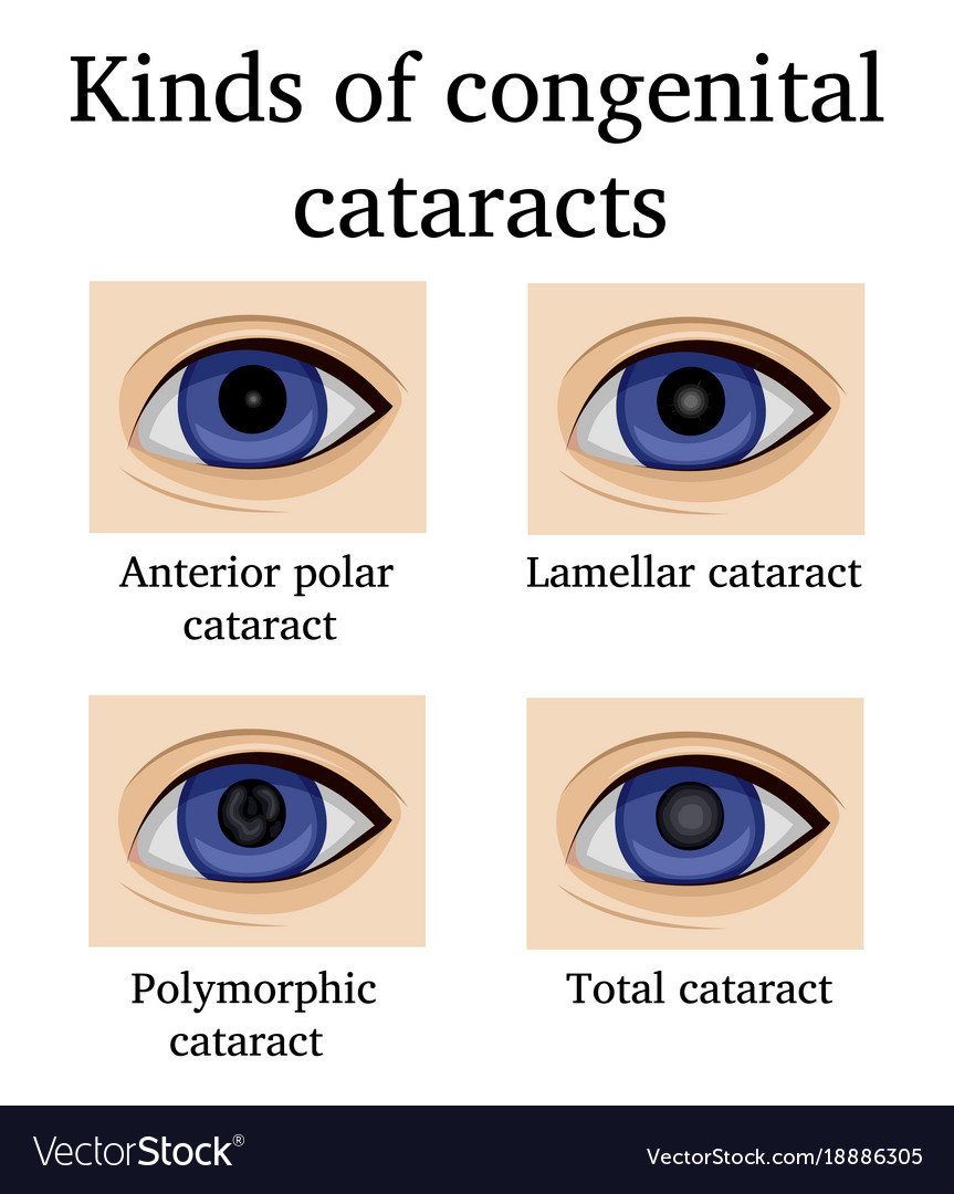 cataracts types