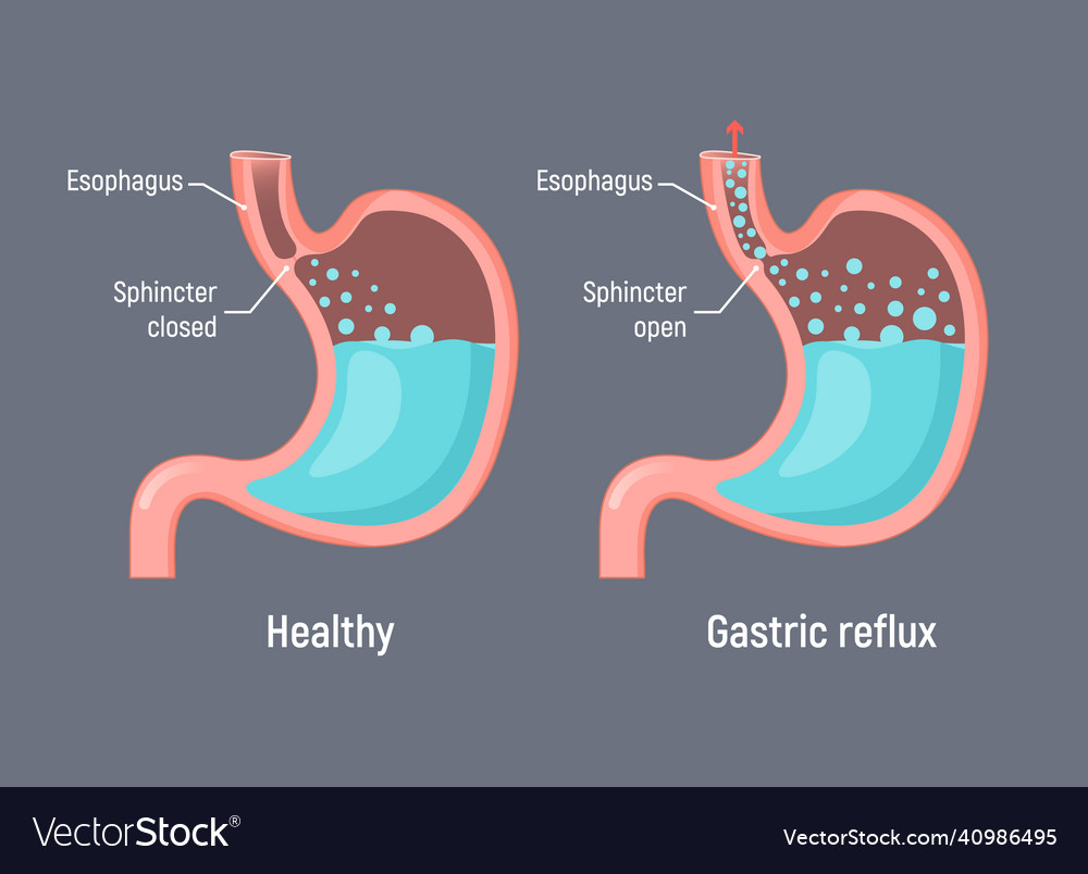 Esophageal gastric reflux acid indigestion