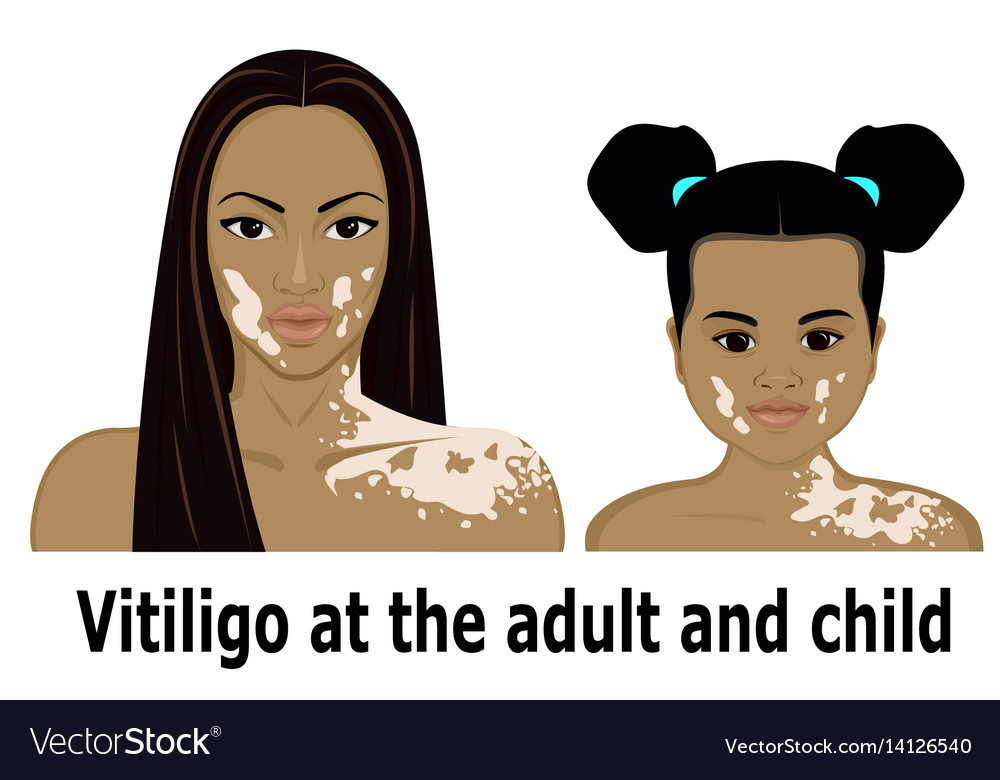 Vitiligo bei Erwachsenen und Kind