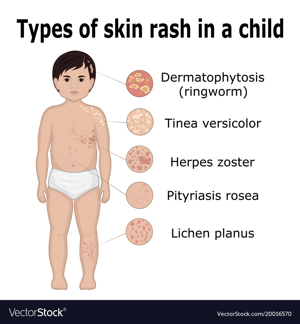 Types Of Child Rashes