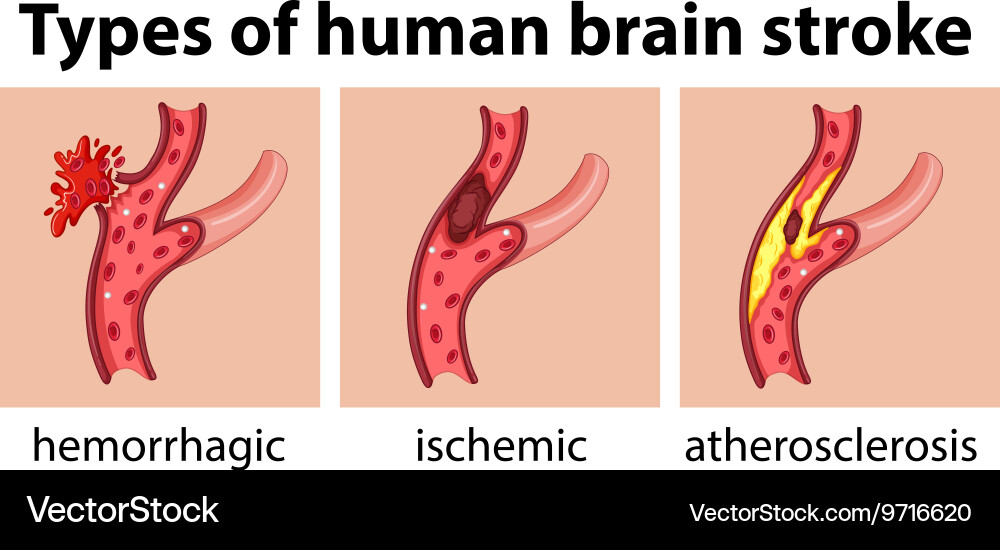Types human brain stroke Royalty Free Vector Image