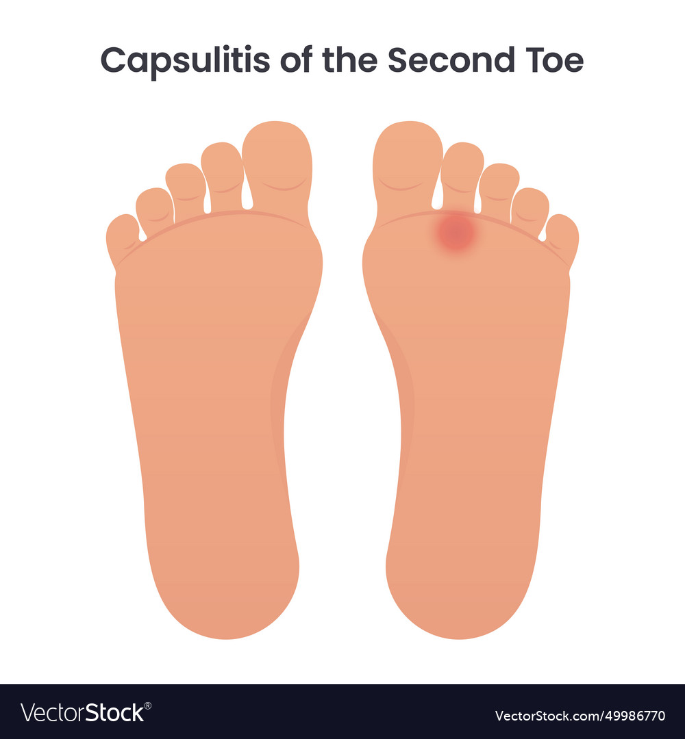 Capsulitis of the second toe royalty free vector image