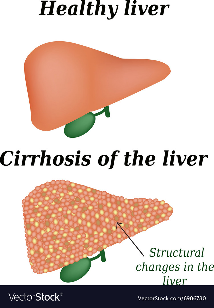 Cirrhosis of the liver Royalty Free Vector Image