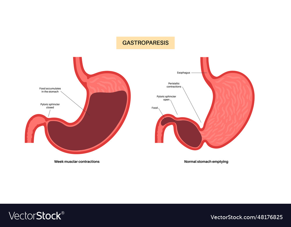 Gastroparesis anatomical poster Royalty Free Vector Image