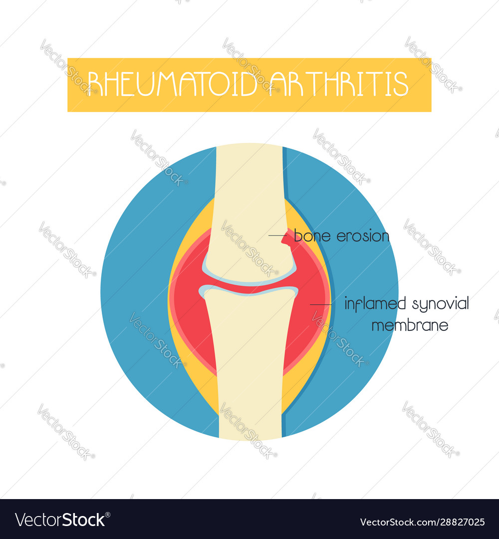 A bone with rheumatoid arthritis Royalty Free Vector Image