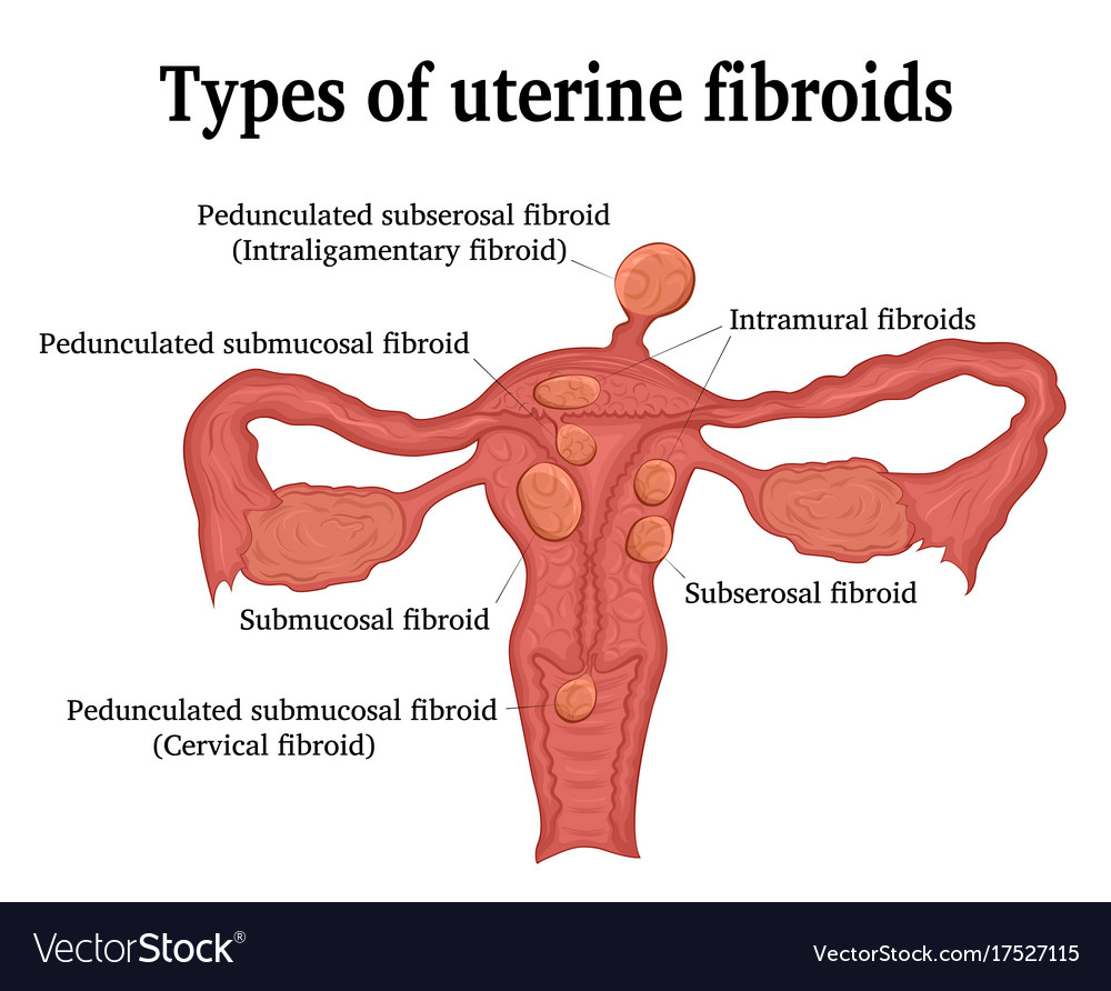 Types Of Uterine Fibroids Royalty Free Vector Image