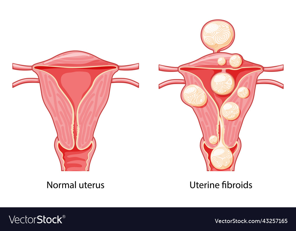 Set Of Uterine Fibroids Female Leiomyomas Vector Image