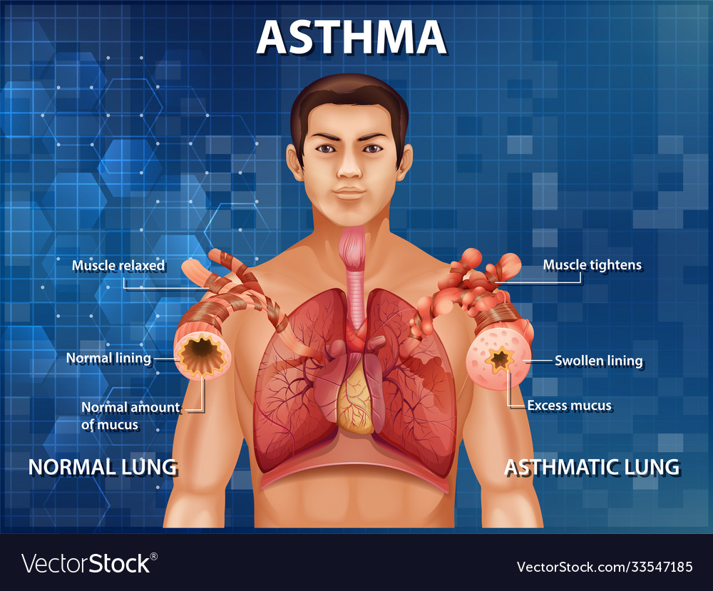 Human anatomy asthma diagram Royalty Free Vector Image