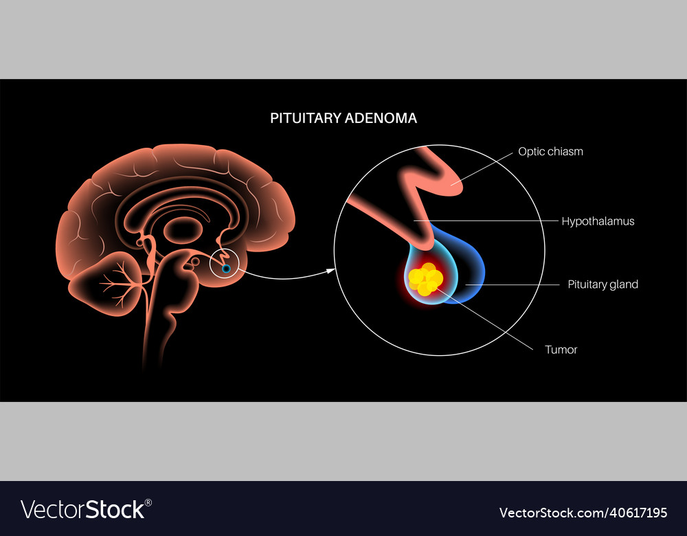 Pituitary Adenoma Cancer Royalty Free Vector Image 2929