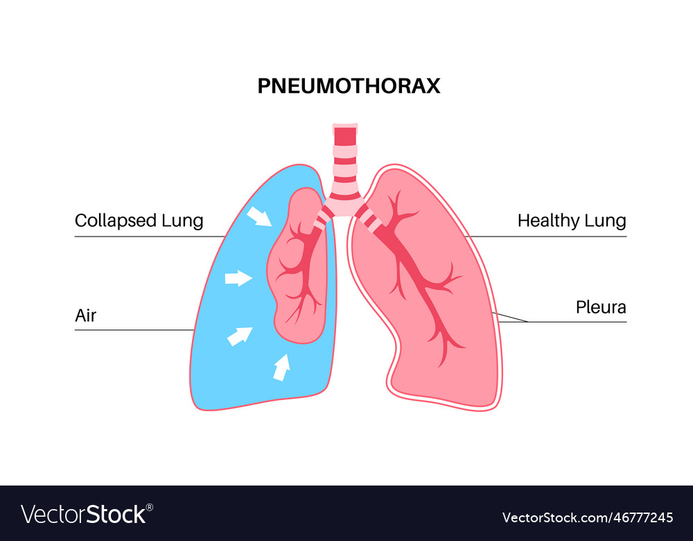 Pneumothorax anatomical poster Royalty Free Vector Image