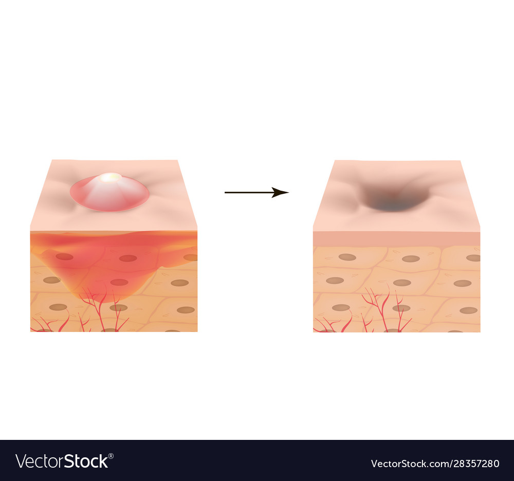 Inflamed acne on skin pimple Royalty Free Vector Image