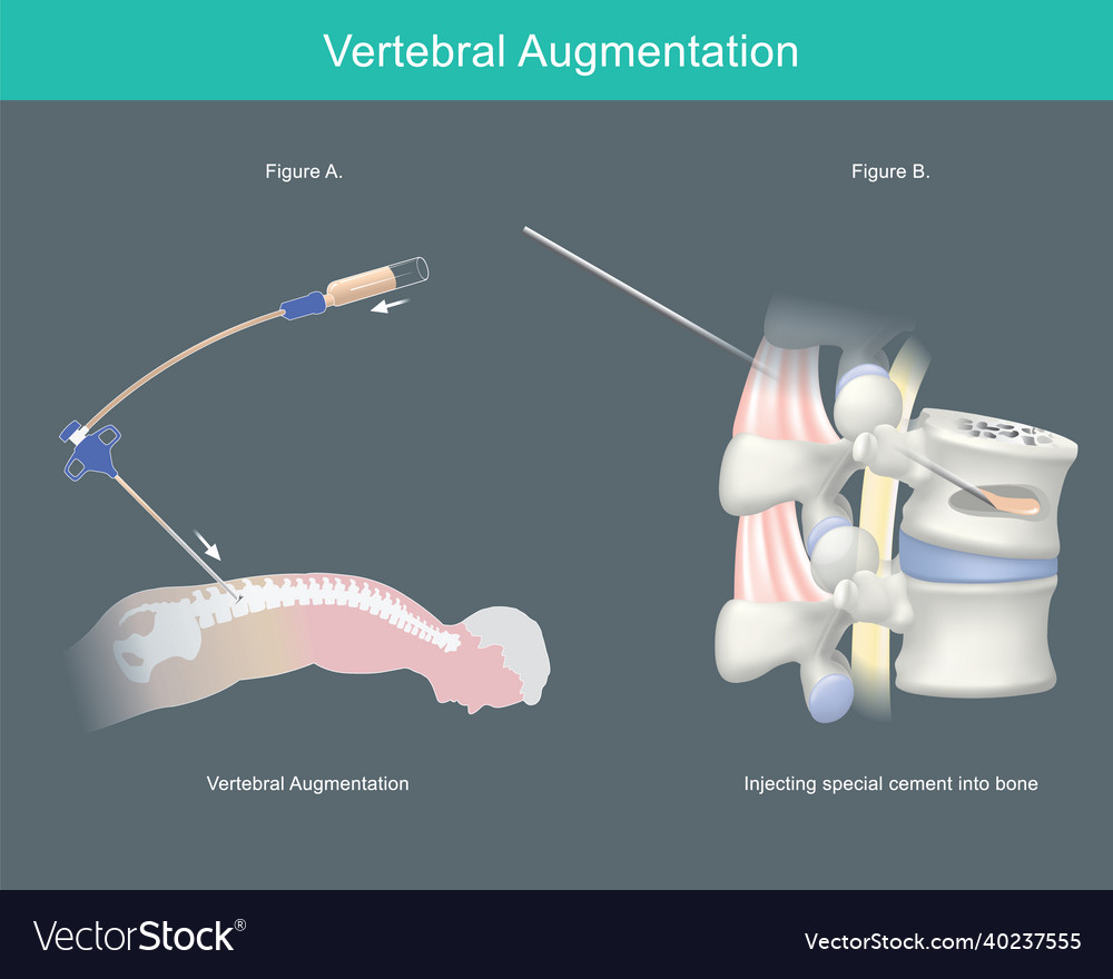 Vertebral augmentation a sample procedure special