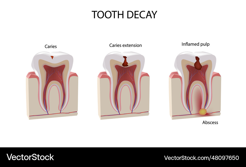 Tooth damage stages realistic dental Royalty Free Vector