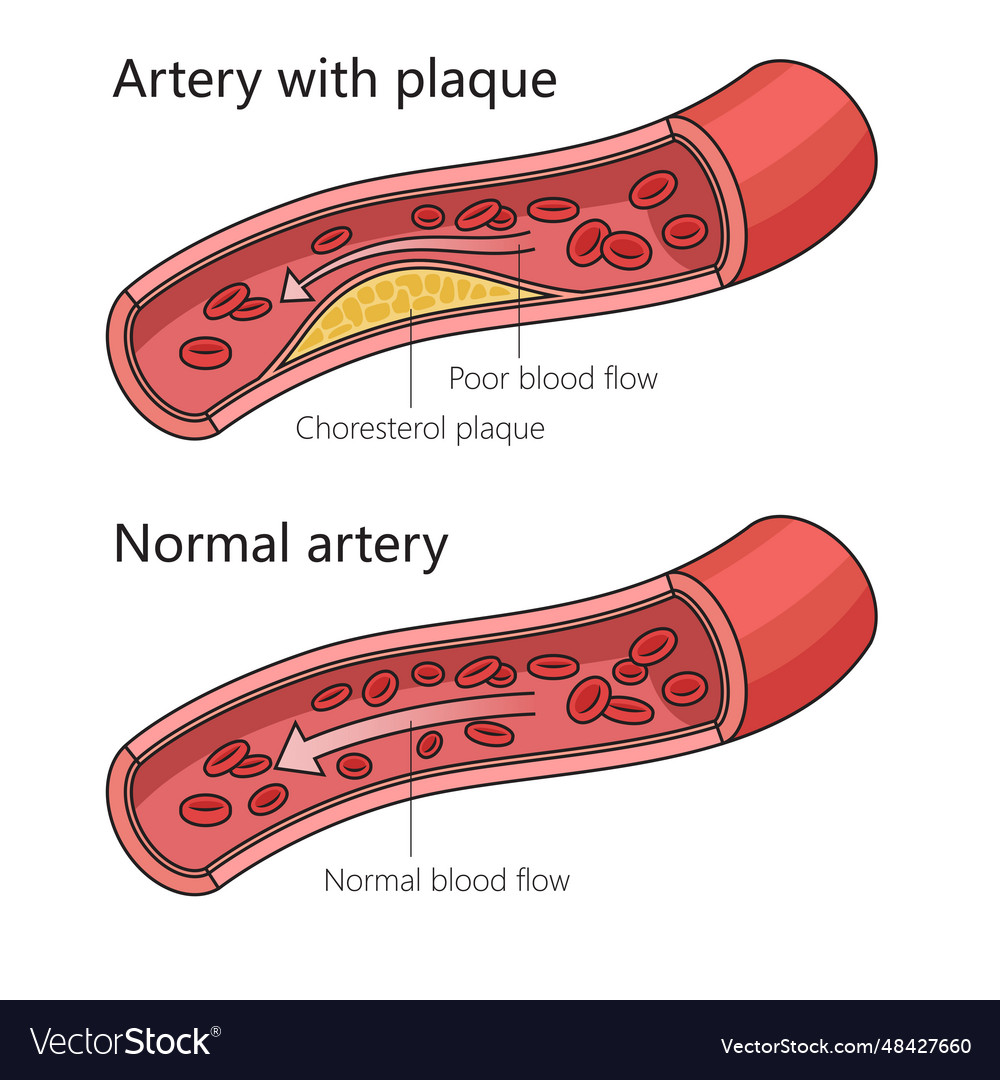 Arteriosclerotic vascular disease diagram science Vector Image