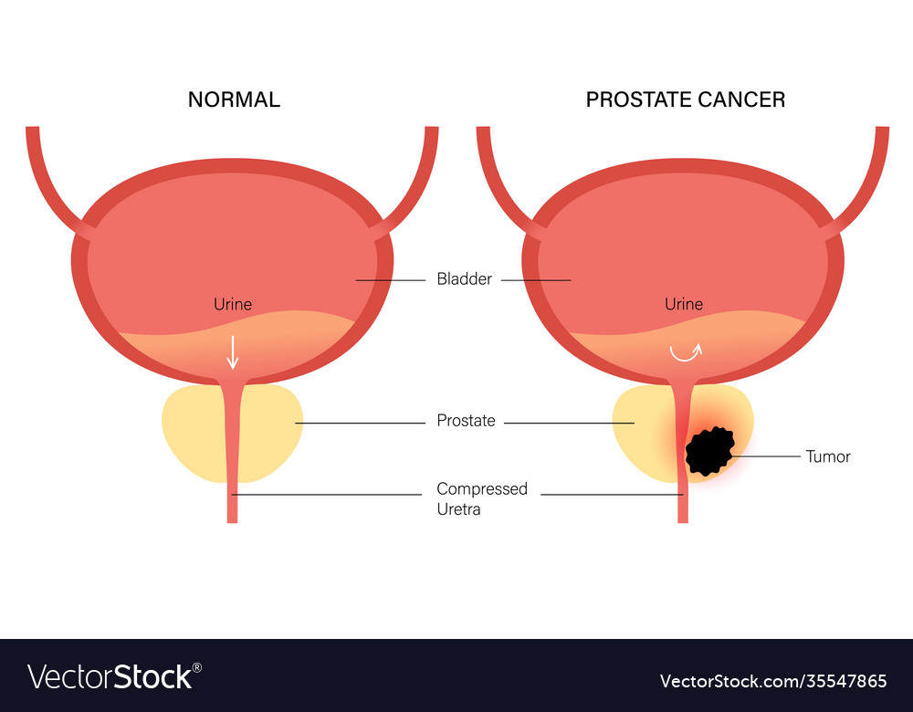 Prostate Cancer Concept Royalty Free Vector Image